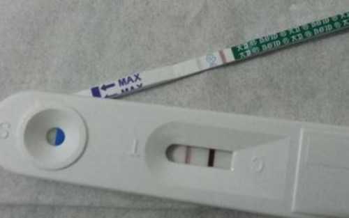 输卵管粘连不孕