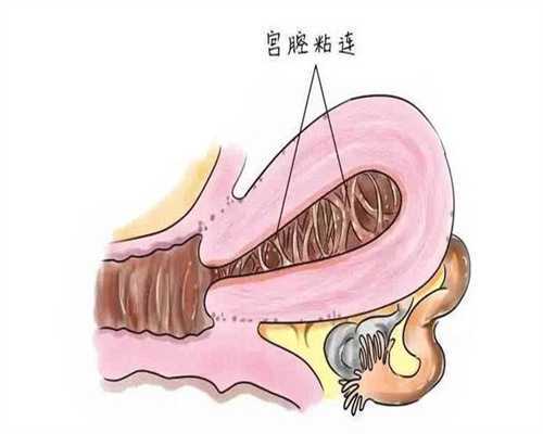 单角子宫不孕
